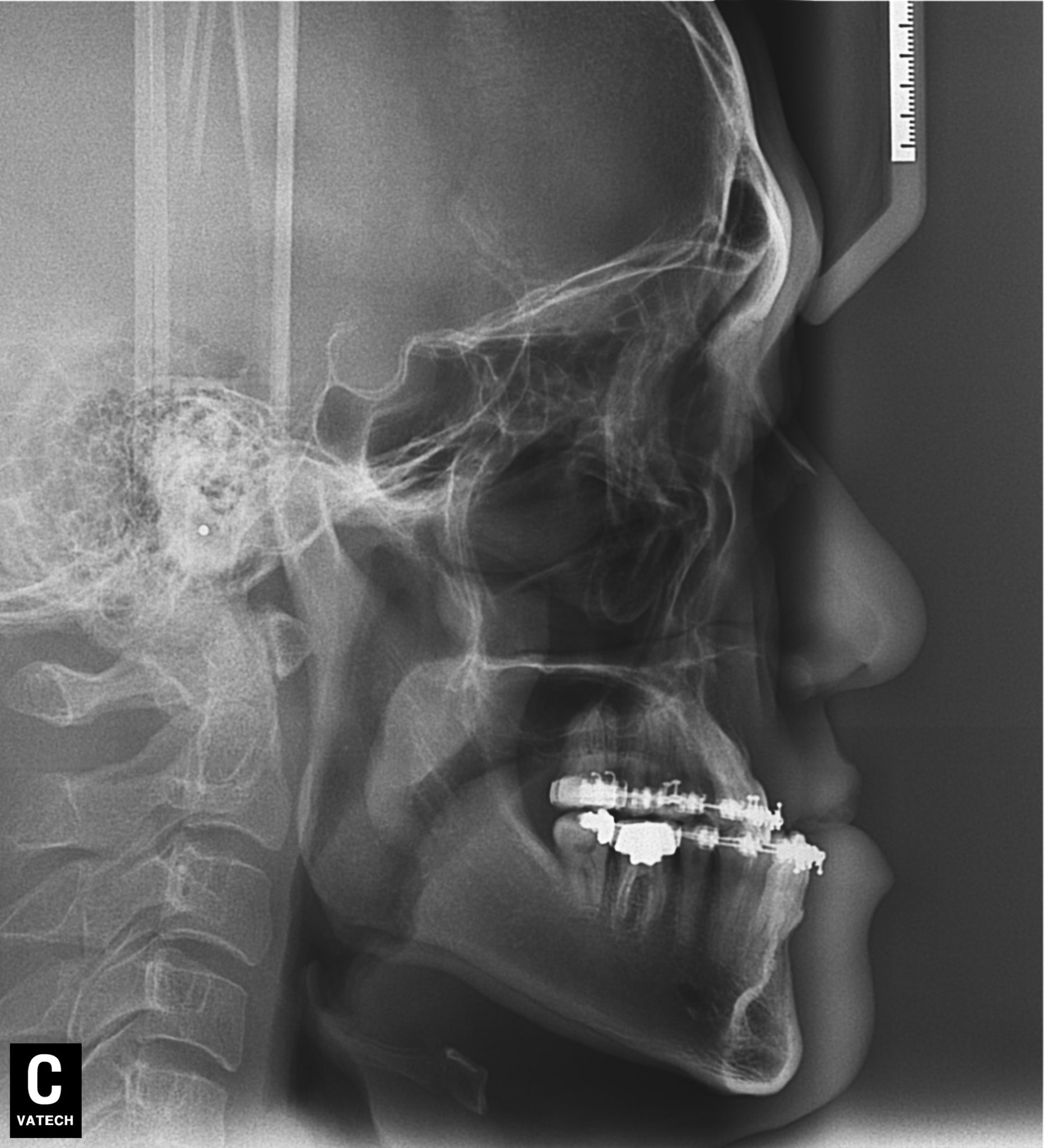 Class 3 jaw X Ray
