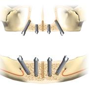 Good News for those with Missing Teeth – Immediate Function All-on-4 Dental Implant Procedure is Available