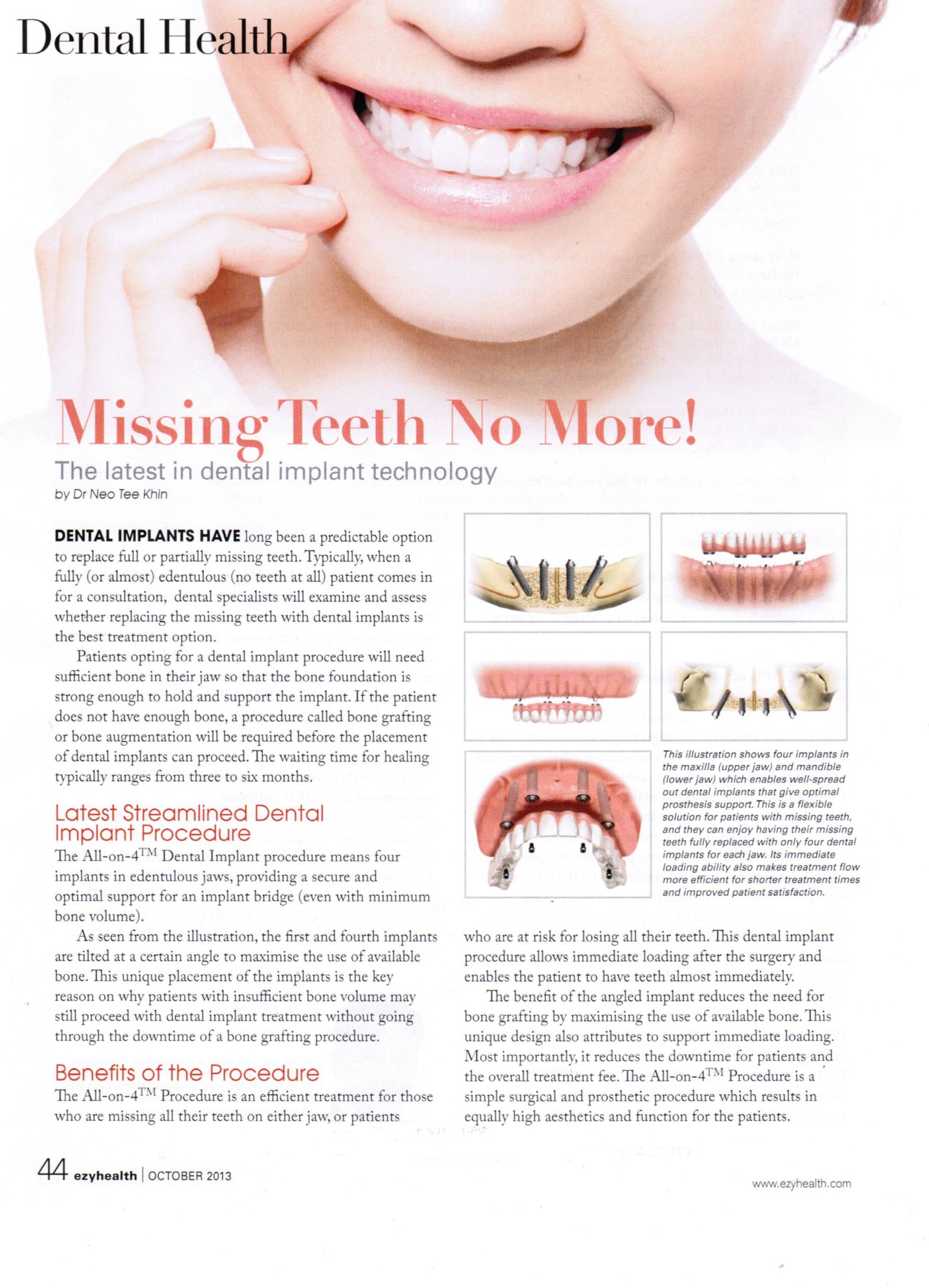 Ezyhealth Magazine, October 2013 issue: “Missing Teeth No More! The latest in dental implant technology”