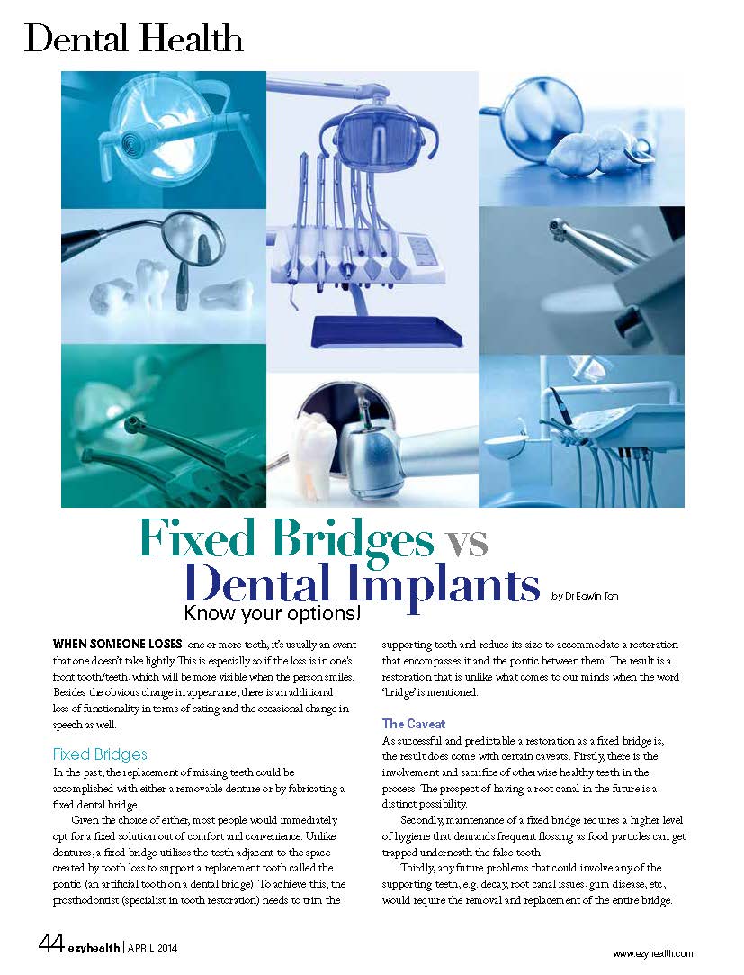 Ezyhealth Magazine, April 2014 issue: “Fixed Bridges VS Dental Implants”  (zh)