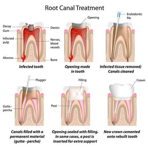 Root Canal Treatment