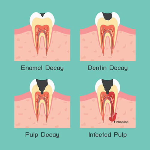 8 things you need to know about Cavities