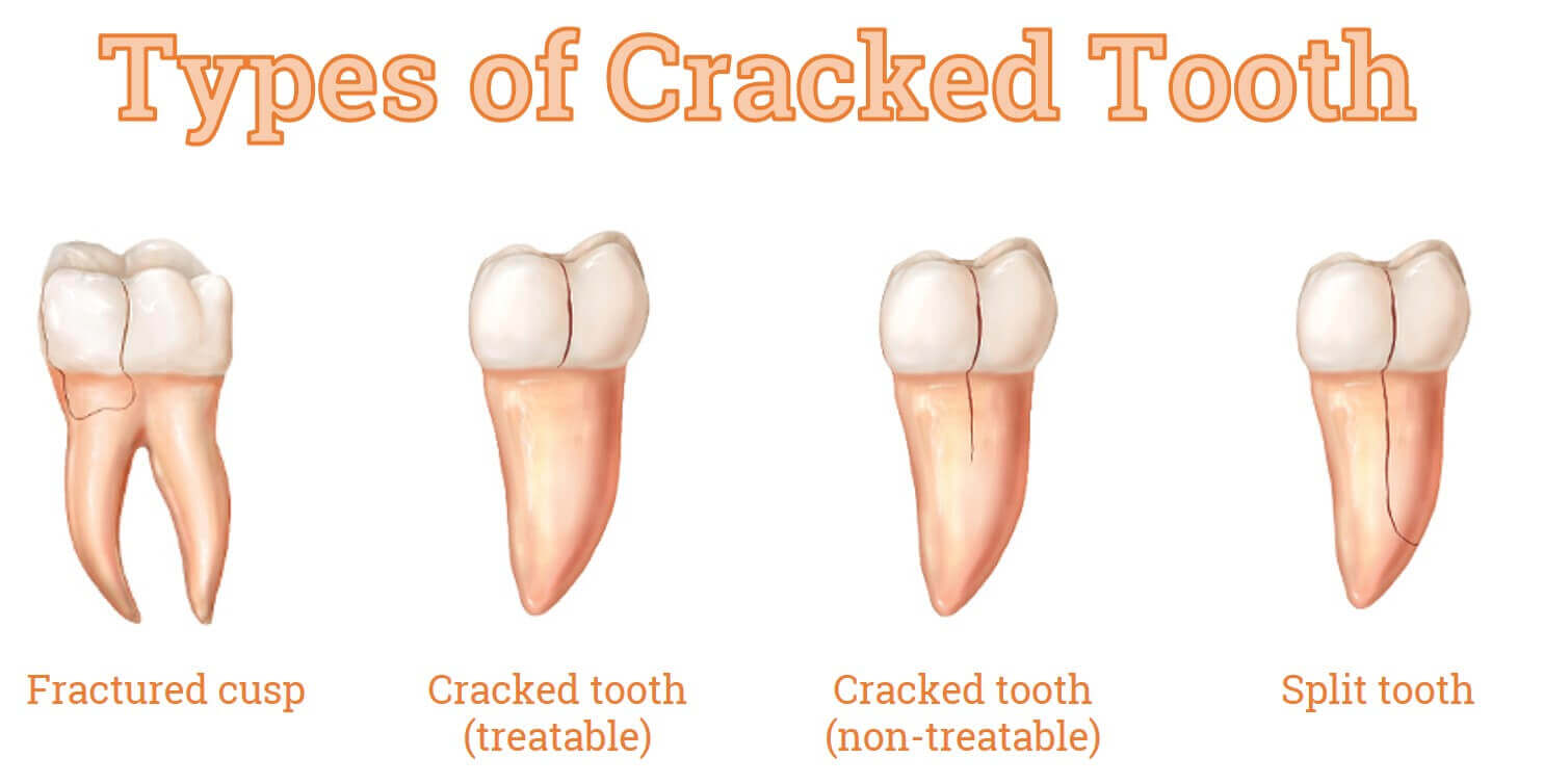 Cracked Tooth | Specialist Dental Group