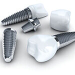 Immediate Placement of Dental Implants
