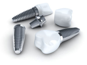 Immediate Placement of Dental Implants