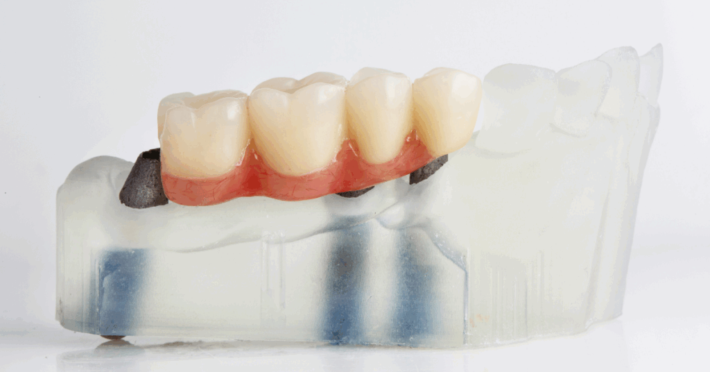 Dental bridge | Missing tooth
