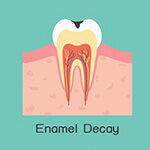 Cavities_Tooth Decay_Specialist Dental Group_150px