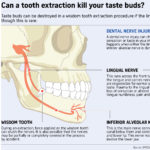 Bisakah pencabutan gigi membunuh selera Anda? Cari tahu saraf yang terkena.