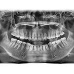 How Much Radiation is there in a Dental X-Ray?