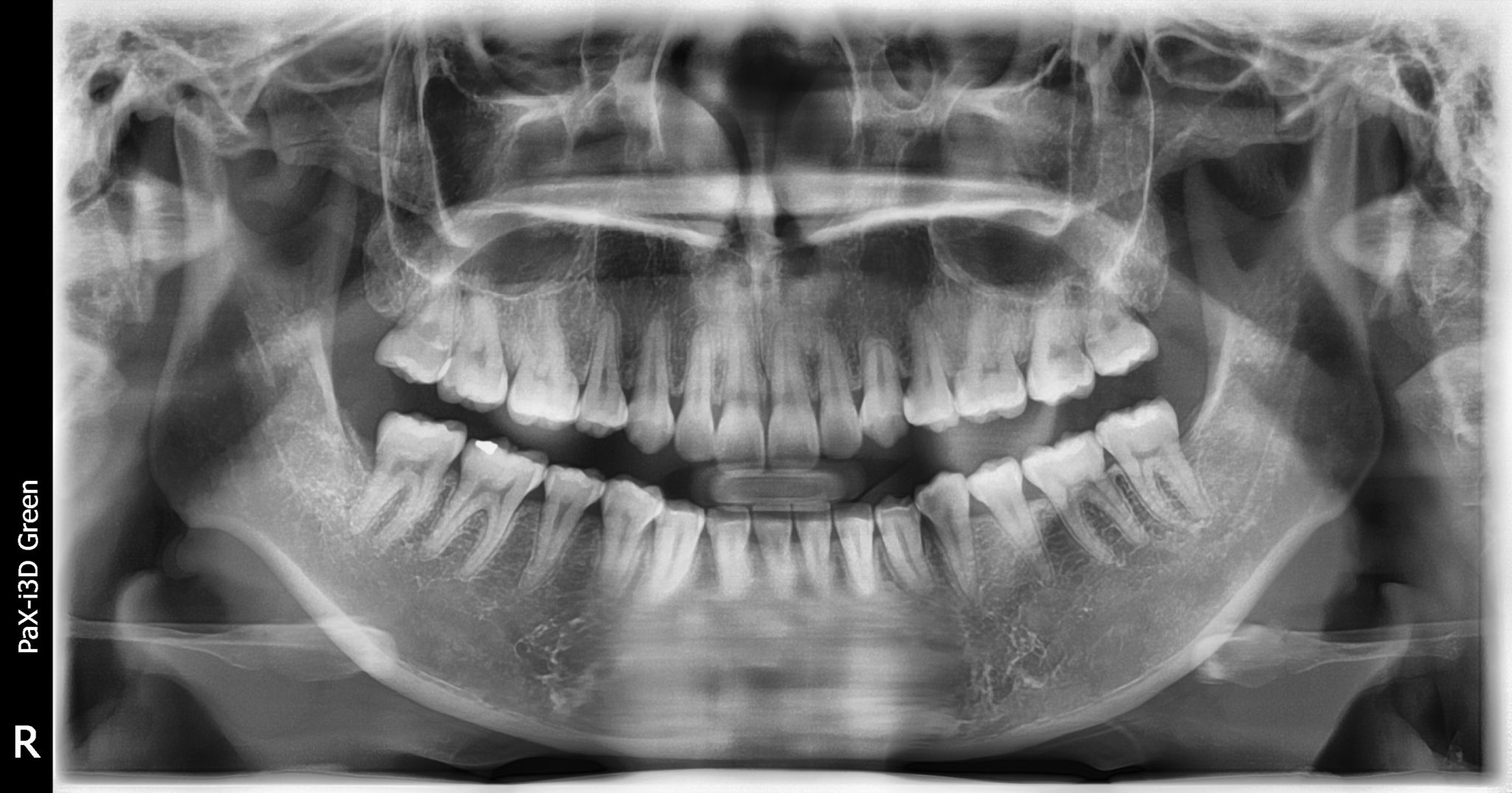 How Much Radiation is there in a Dental XRay?
