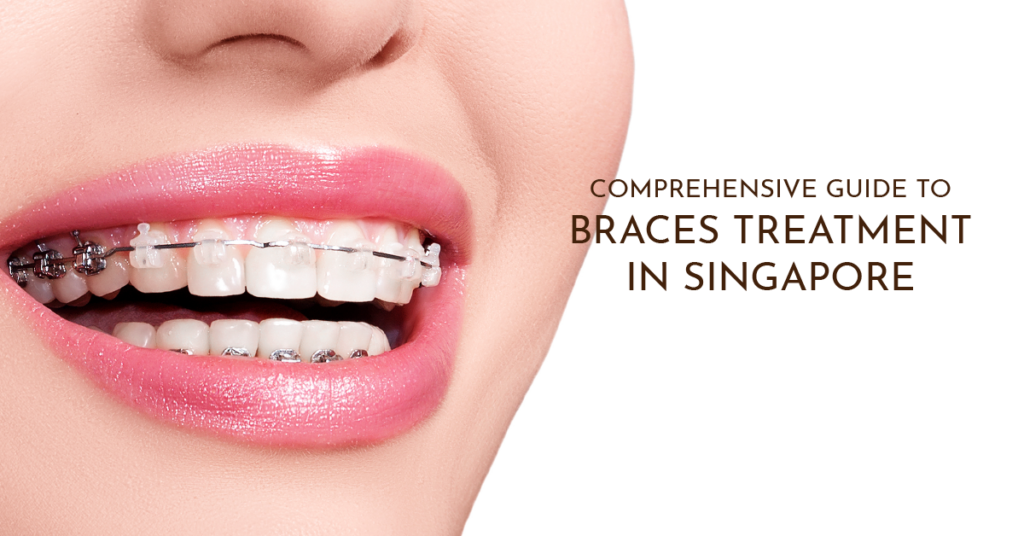 A comprehensive guide to braces treatment in singapore | Specialist Dental Group