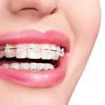 A Comprehensive Guide to Braces Treatment in Singapore