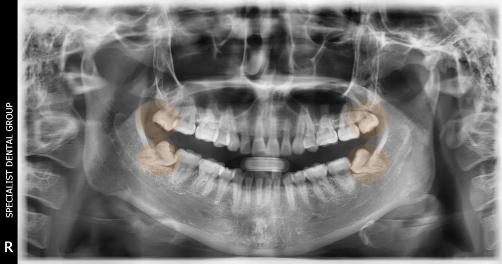 A patient with four wisdom teeth where two lower impacted wisdom teeth are growing at an awkward angle