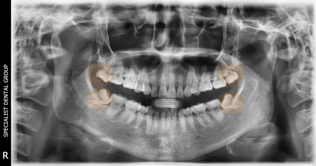 Seorang pasien dengan empat gigi bungsu di mana dua gigi bungsu impaksi bawah tumbuh pada sudut yang canggung