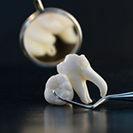 What you need to know about Post-Wisdom Tooth Extraction or Surgery Recovery