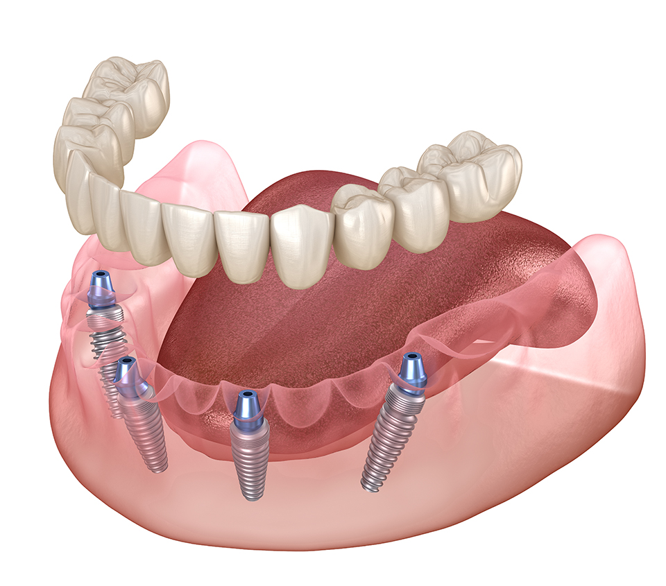 all on 4 dental implant