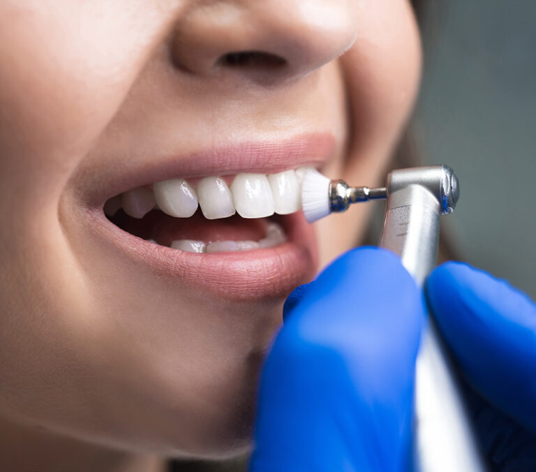 Scaling & polishing Specialist Dental Group