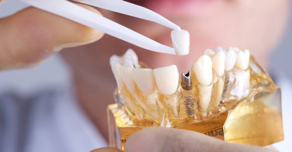 What happens when my dental implants fail | Specialist Dental Group