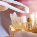 What happens when my dental implants fail | Specialist Dental Group