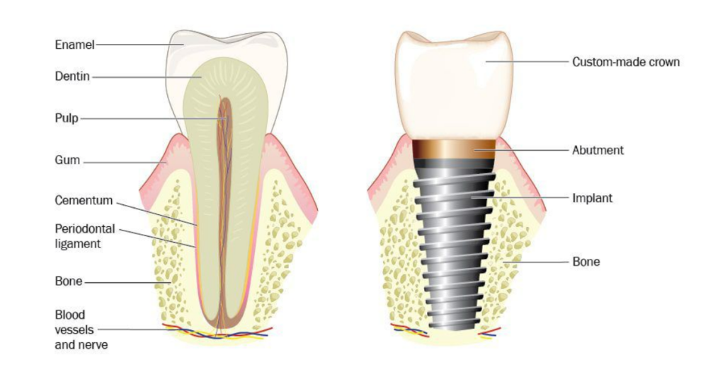 What happens when my dental implants fail | Specialist Dental Group