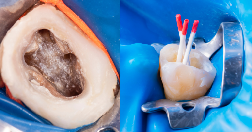 root canal treatment in process | comprehensive guide to root canal treatment | specialist dental group blog | endodontics | endodontist