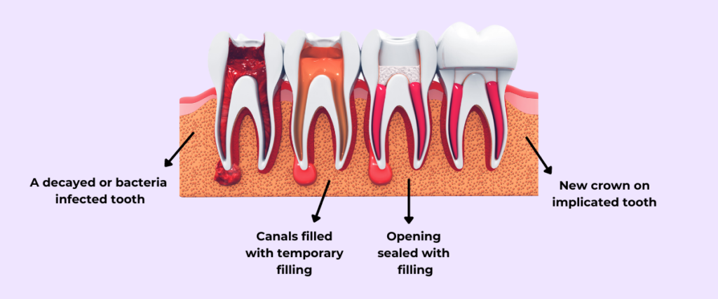 root canal treatment process | comprehensive guide to root canal treatment | specialist dental group blog | endodontics | endodontist