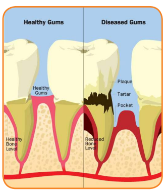 dental implants singapore | crowns and bridges | tooth loss | dental specialist singapore | dental restoration treatments | healthy gums | diseased gums