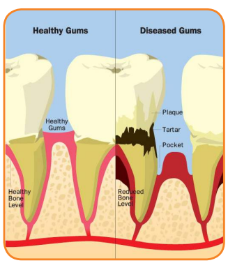 Comparison of healthy gums vs diseased gums: Infographic