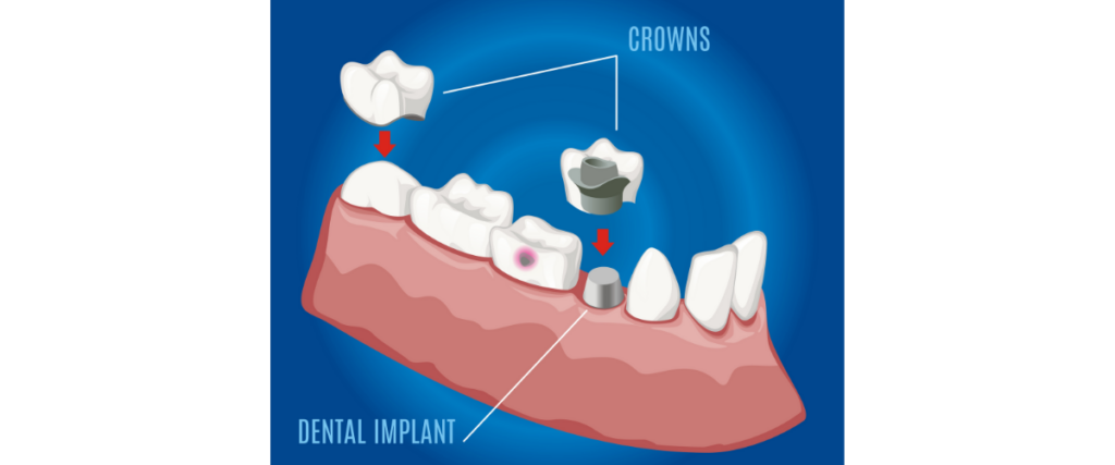 Dental crown on a dental implant: Infographic