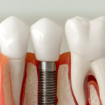 dental implants | dental specialist | missing teeth