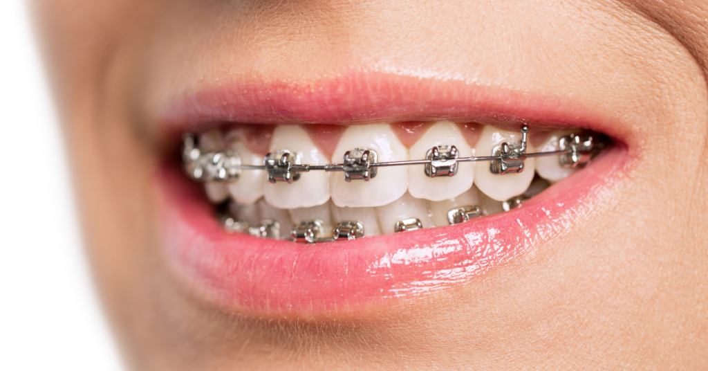 stainless steel braces 