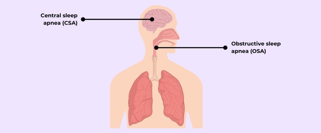 睡眠呼吸暂停的类型