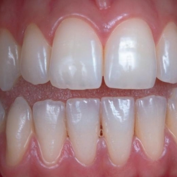 Receding gums